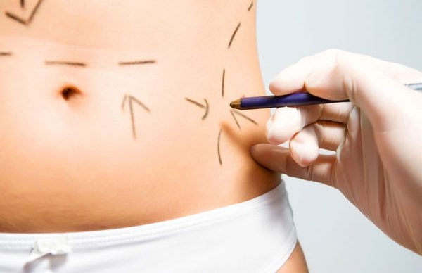 Liposuction nedir?