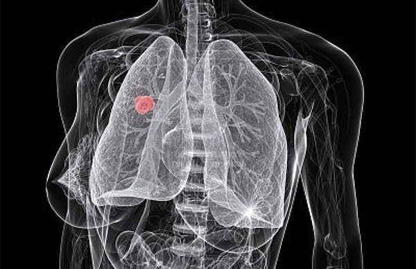 Akciğer kanseri ilk evrede teşhisle önlenebilir