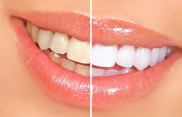 Pratik diş beyazlatma önerileri