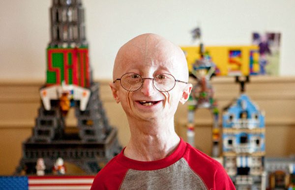 Progeria hastalığı nedir?