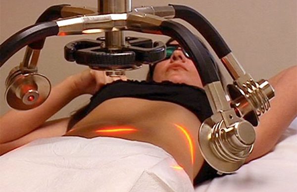 Lazer yardımlı liposuction